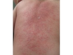 膿疱性乾癬の診断方法