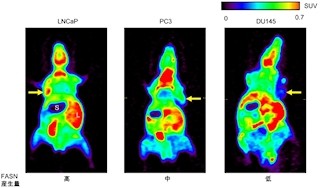 「脂肪酸合成酵素」を多量産生するがんに有効な診断法と治療法 - NIRSなど