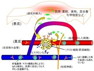 汗に含まれるアトピー性皮膚炎の悪化因子はカビの1種の産生物 - 広島大