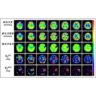 国循、計測時間10分の脳血流・代謝PET検査システムを開発 -臨床応用を開始