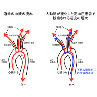 東北大、大動脈の硬化に伴う脳梗塞の発症メカニズムを解明