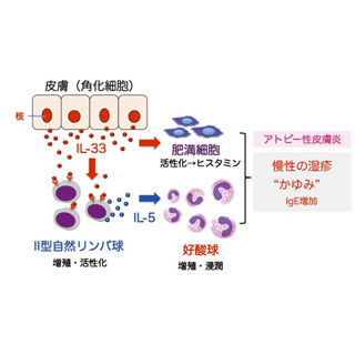 皮膚で増加したIL-33がアトピー性皮膚炎を引き起こす - 兵庫医大が発見