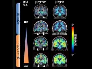 NIRSなど、アルツハイマー病の2大病変の1つ「タウ」の画像化技術を開発