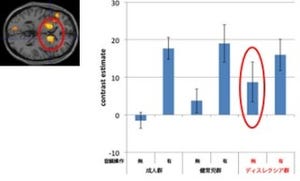 NCNPなど、「発達性読み書き障害」で脳の2領域に異常があることを確認
