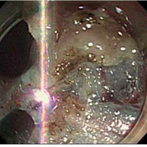 大腸がんの処置時間短縮効果などを確認 - 岡山大が開発した内視鏡用機器