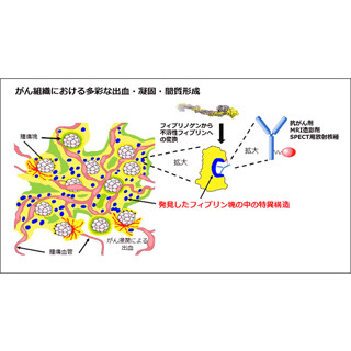 治療がすぐに必要か、様子見が可能ながんかを見極める技術 - 国立がん研