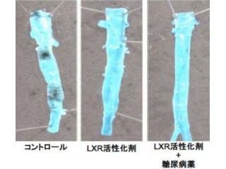 「肝臓X受容体」の活性化が動脈硬化の進展を抑制する - 名大など