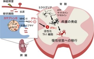 九大、「神経障害性疼痛」の慢性化の仕組みの一部を解明