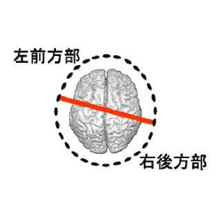 自閉症スペクトラム障害の脳は左前方部と右後方部のつながりが低い -金沢大