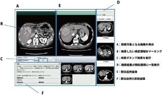富士フイルム、医師の画像診断をサポートするシステムに肝臓がんを追加