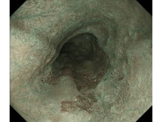 低負担の早期食道がん診断が可能に - 大阪市立大、NBI内視鏡の有用性を確認