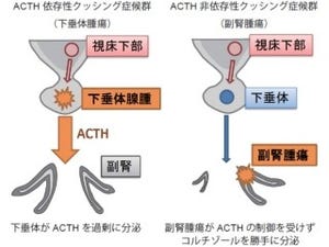 東大など、「ACTH非依存性クッシング症候群」のメカニズムなどを解明