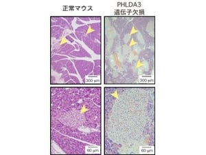 国がん、希少がん「すい神経内分泌腫瘍」のカギは遺伝子「PHLDA3」