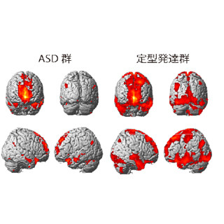 自閉症スペクトラム障害は安静状態の脳の機能連結が弱い - 名大などが確認
