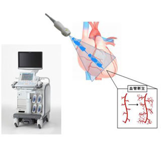 東北大、超音波に血管新生作用と発表 - 狭心症の新たな治療法として期待