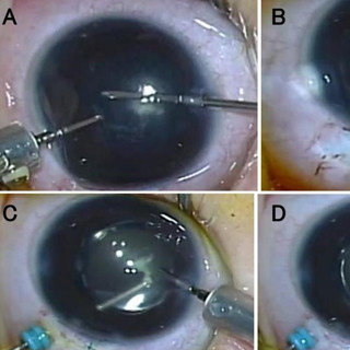 岡山大、生後18カ月以内の片眼性先天白内障向け眼内レンズ挿入の安全性を確認