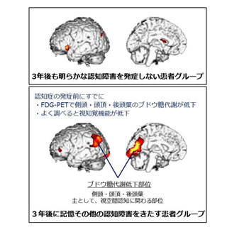 東北大、パーキンソン病の悪化に関連する脳部位を特定
