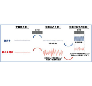 統合失調症のγ帯域脳自発活動が音で上昇