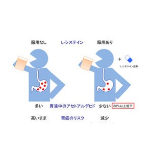 L-システインの投与が胃がんのリスクを減らす!? - 東北大が確認