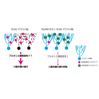 脊髄小脳失調症6型の悪化に脳内免疫システムが関与 - 東京医科歯科大