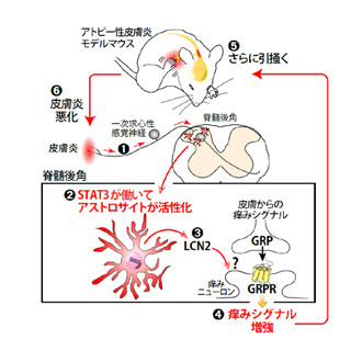 九大、アトピー性皮膚炎の慢性的な痒みのメカニズムに関わる細胞を発見