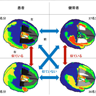 NICTなど、脳の活動を元にした客観的な統合失調症の推定手法を開発