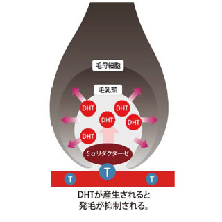 アンファーなど、AGAリスクを簡易的に判定する検査技術を開発