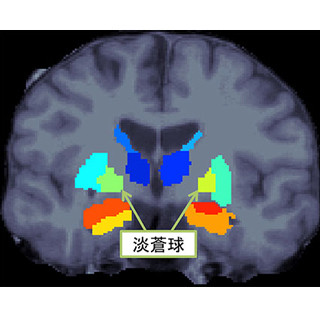 阪大など、統合失調症患者の脳で左右の体積がアンバランスな部位を発見