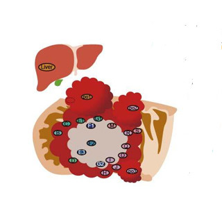 大腸がんは異なる遺伝子変異を持つ不均一な細胞で構成されている - 九州大