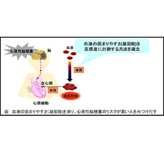 血液の固まりやすさ正確に計測 脳梗塞リスク判断に威力