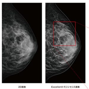 富士フイルム、AI利用の高精度な画像処理技術 - 乳がん検査用ソフトに搭載