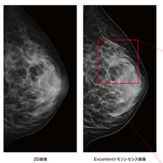 富士フイルム、AI利用の高精度な画像処理技術 - 乳がん検査用ソフトに搭載