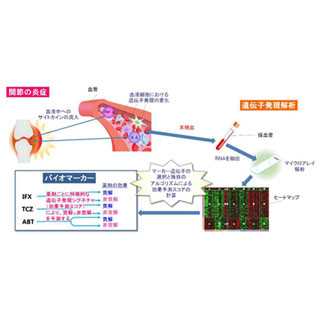 慶大など、関節リウマチの薬剤効果を予測するバイオマーカーを特定