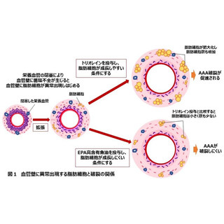 腹部大動脈瘤の破裂は、血管壁内の脂肪細胞が原因 - 近大がメカニズム解明