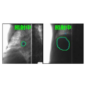 東芝と量研機構、重粒子線がん治療装置向け腫瘍追跡技術 - 画像認識を利用
