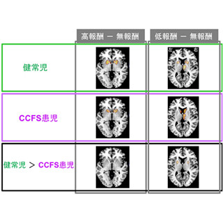 小児慢性疲労症候群では、報酬の感受性が低下している - 理研などが発表