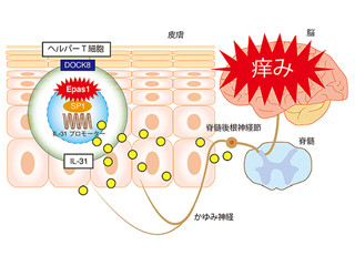 九大、アトピー性皮膚炎のかゆみを起こすタンパク質を発見-作用機所も解明