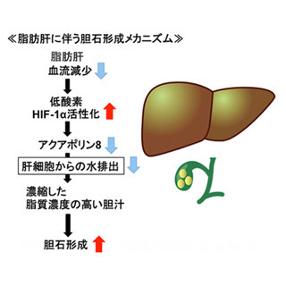 メタボだと胆石が増えるメカニズムを解明 東北大学