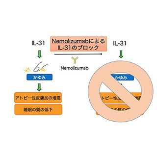 京大、抗IL-31抗体によるアトピー性皮膚炎のかゆみ抑制を確認