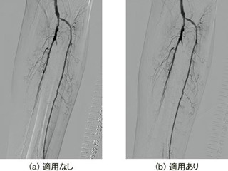 島津製作所、低侵襲・効率的な血管内治療を支援する画像処理技術を開発