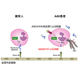 難治性血管炎の免疫チェックポイント分子を発見-病態解明の手掛かりに