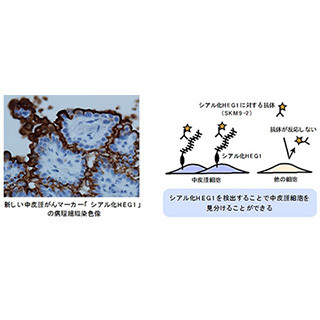 神奈川がんセンター、新しい中皮腫がんマーカー「シアル化HEG1」を発見