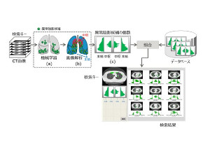 富士通研究所、CT画像をもとにAIで立体的な異常陰影の類似性を確認する技術