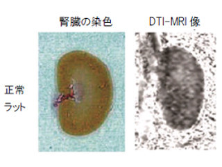 阪大、糖尿病による腎障害の画像化に成功 - 正確な評価手法実用化に期待