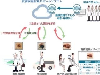 AIで皮膚がんなどの診断を可能とするシステム-KCCSなどが開発を開始