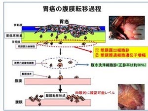大阪市大、胃癌の腹膜転移予測に有用な術中診断法を開発- 臨床試験を開始