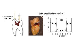 見えない虫歯も発見可能に - pHマッピングでう蝕の定量的検査技術を開発