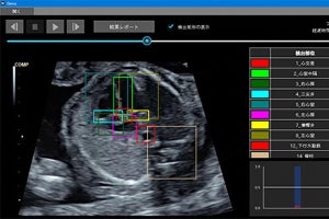 AIで胎児の心臓異常をリアルタイムで検知する技術 - 理研などが開発