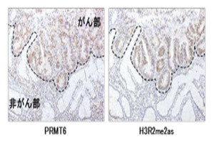 胃がんのヒストン修飾の異常による悪性化メカニズムを解明 - TMDU