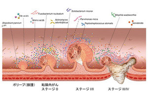 40兆個もある腸内細菌の中から大腸がん発症に関わる菌種を見つけた 早期診断の新検査法に道